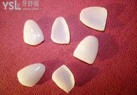 醫(yī)生建議做烤瓷牙貼面要謹(jǐn)慎？