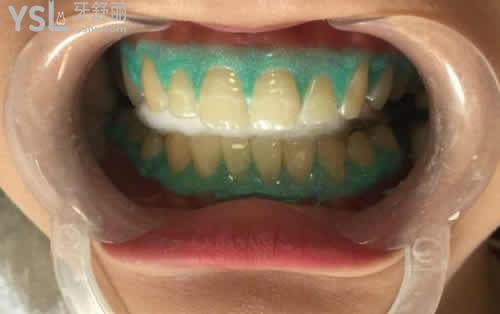 皓齒美白的技術優(yōu)勢？
