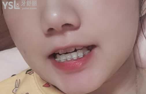 二十歲矯正牙齒后悔，只要去正規(guī)的口腔醫(yī)院就不會(huì)給你后悔的機(jī)會(huì)