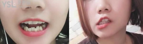 二十歲矯正牙齒后悔，只要去正規(guī)的口腔醫(yī)院就不會(huì)給你后悔的機(jī)會(huì)