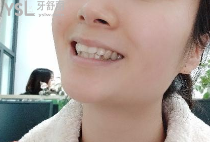 帶牙套后悔一輩子，我覺(jué)得不帶牙套才會(huì)后悔