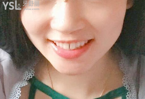 戴牙套一個月不想戴了，矯正的結(jié)果是值得你堅持下去的，加油。
