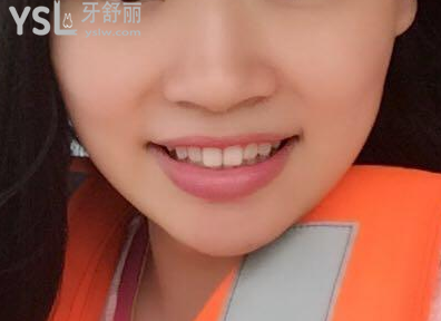 戴牙套一個月不想戴了，矯正的結(jié)果是值得你堅持下去的，加油。