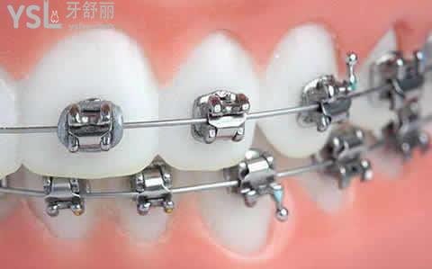 金屬自鎖矯正的優(yōu)勢所在？