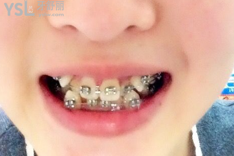 20歲整牙還來得及嗎，有想法的時(shí)候立馬行動(dòng)到時(shí)候你會(huì)感謝我的