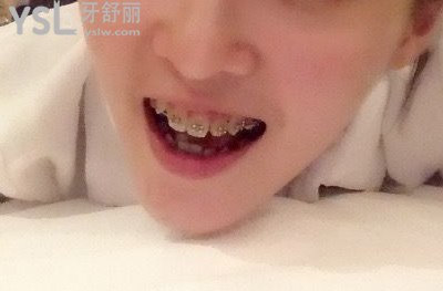 20歲整牙還來得及嗎，有想法的時(shí)候立馬行動(dòng)到時(shí)候你會(huì)感謝我的