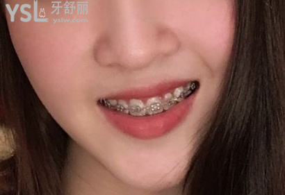 20歲整牙還來得及嗎，有想法的時(shí)候立馬行動(dòng)到時(shí)候你會(huì)感謝我的