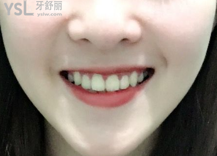 20歲整牙還來得及嗎，有想法的時(shí)候立馬行動(dòng)到時(shí)候你會(huì)感謝我的