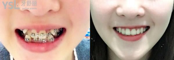 20歲整牙還來得及嗎，有想法的時(shí)候立馬行動(dòng)到時(shí)候你會(huì)感謝我的