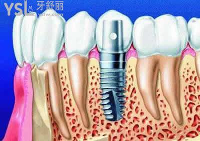 種植牙價(jià)格相差這么多的區(qū)別在哪？