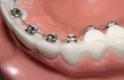 陶瓷矯正的優(yōu)勢(shì)：