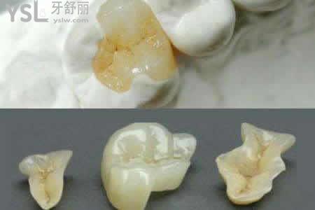 樹脂補牙使用的壽命與那些因素有關？