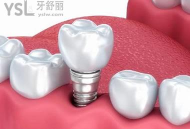 種植牙一般都有哪些優(yōu)點(diǎn)？