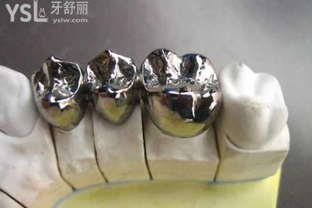 鈷鉻合金烤瓷冠的價(jià)格：