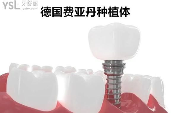 德國(guó)費(fèi)亞丹種植體