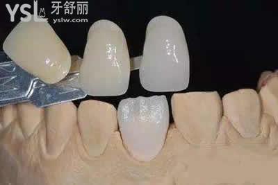 為什么有的人做了牙貼面會(huì)后悔？