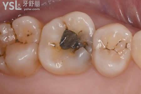 3M進(jìn)口樹脂補(bǔ)牙的優(yōu)勢：