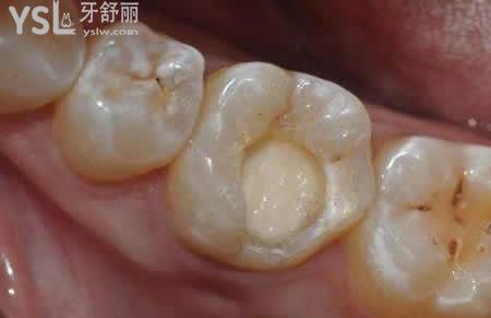 樹脂材料補牙：