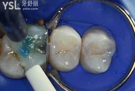樹脂補牙后要注意的：