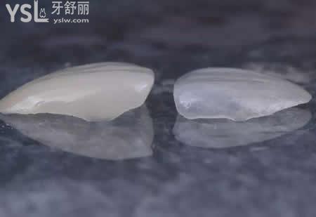做全瓷貼面有哪些要注意的？