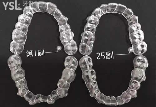 為什越來越多人選擇隱形矯正？