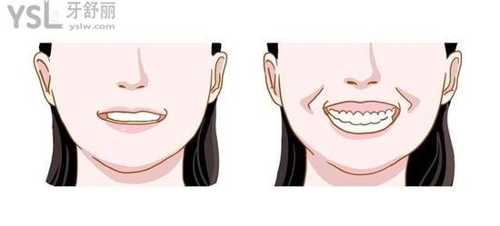 為何深覆合千萬不要矯正？不要被那些賣產(chǎn)品的騙了！