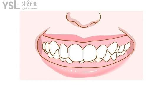 為何深覆合千萬不要矯正？不要被那些賣產(chǎn)品的騙了！
