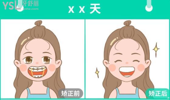 金屬牙套價目表