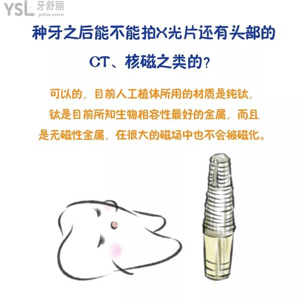 做了種植牙我不想活了？ (4).jpg