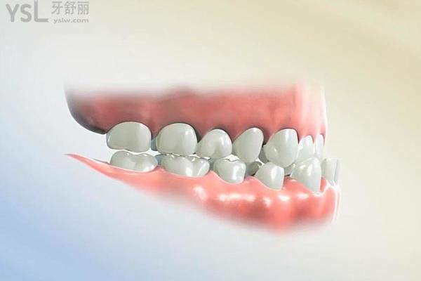 曉萌牙講座016章：揭開(kāi)帶了牙套三年反彈了真相 (2).jpg