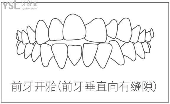 前牙開合