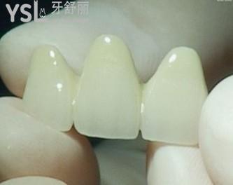愛(ài)爾創(chuàng)全瓷牙