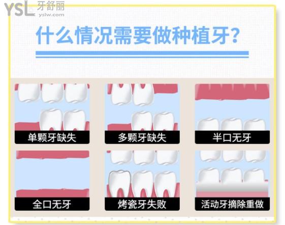 什么情況需要做種植牙