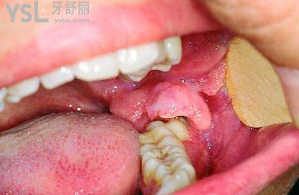 嘴突然張不開了怎么回事1