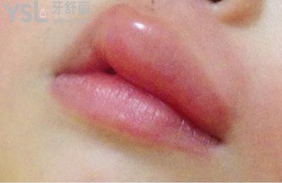 我裂開(kāi)了，嘴突然腫了是什么原因？
