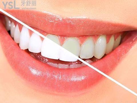 科學(xué)生活大亂斗：教你怎么改善牙黃（怎么牙齒才變得白方法）
