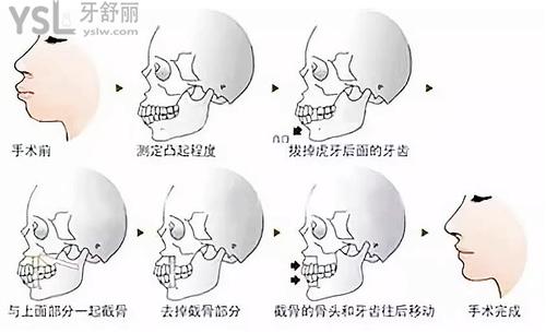 如何判斷正畸還是正頜，正畸和正頜的區(qū)別是什么？來看看