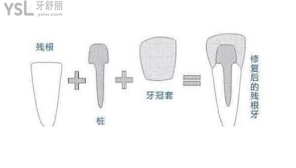 牙根打樁帶冠治療過程圖