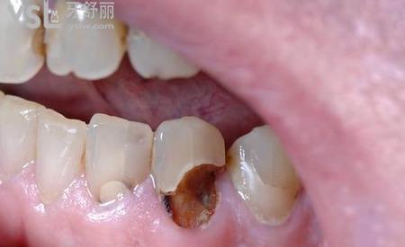 牙齒根部發(fā)炎怎么治療