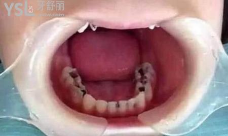 我的一顆大牙爛掉了一半了,應(yīng)該怎么辦？
