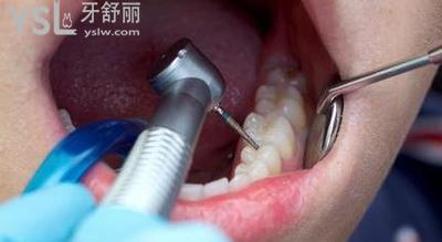 補牙需要多長時間才能補好？
