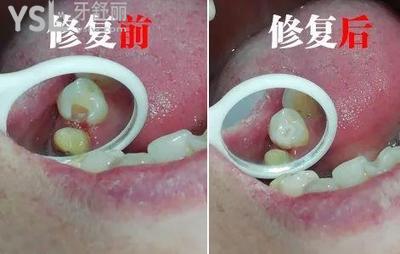 補牙