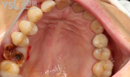 牙窩里白色物體是什么？
