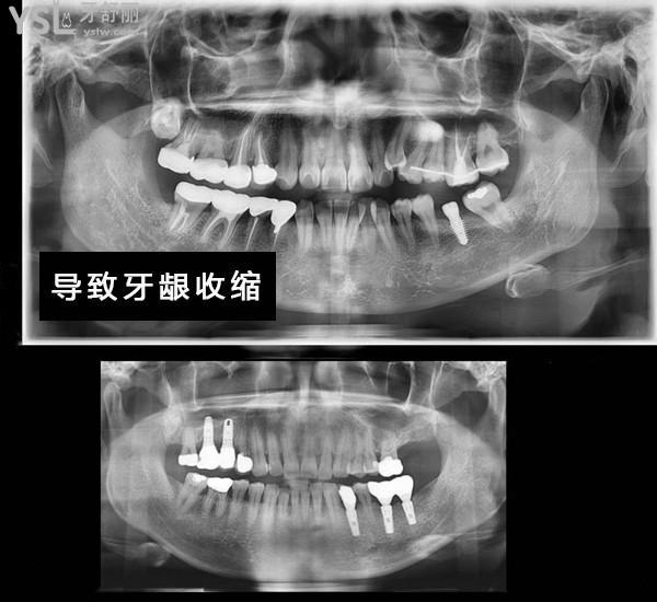 牙缺失十幾年了能種植牙嗎？牙掉了很久了還能種牙嗎？
