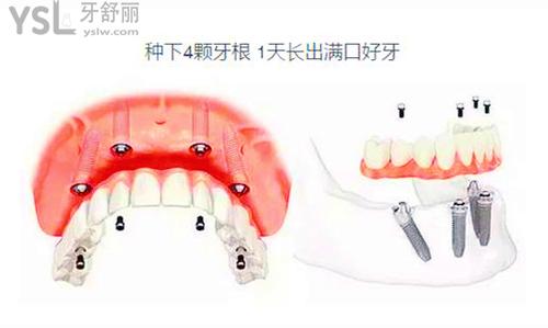 種植牙即拔即種好嗎？2個因素決定