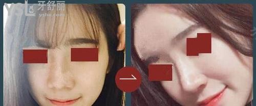 李炳澮院長(zhǎng)做鼻子怎么樣1