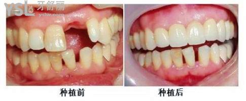 種植牙是真牙還是假牙？