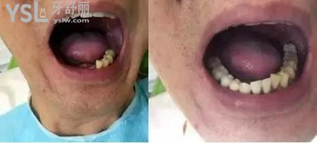 種植牙后可以吃東西嗎？