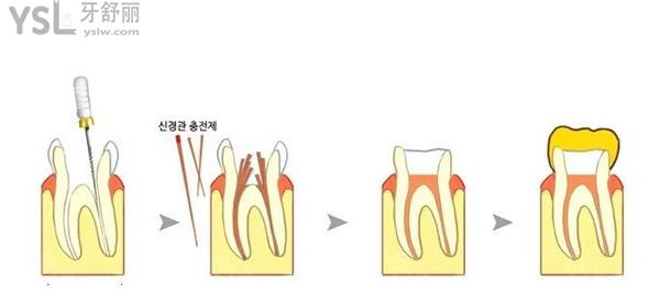 根管治療過程