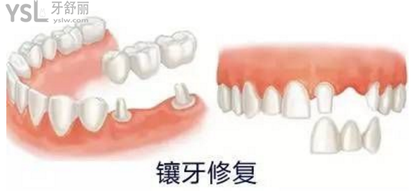 鑲牙疼嗎需要多長時(shí)間